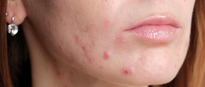 What Causes Pregnancy Acne and How to Treat it Safely