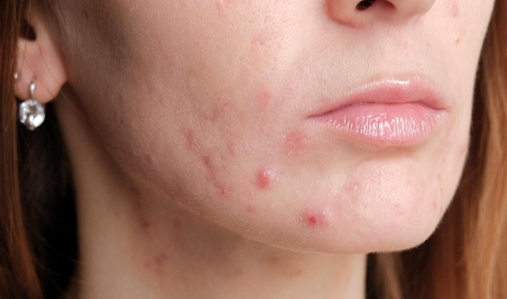 What Causes Pregnancy Acne And How To Treat It Safely 